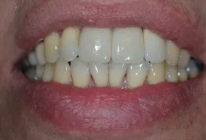 damaged three front teeth after