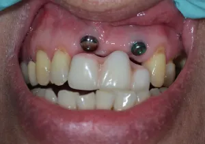 damaged three front teeth before