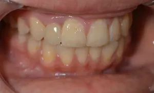replacement dental implant