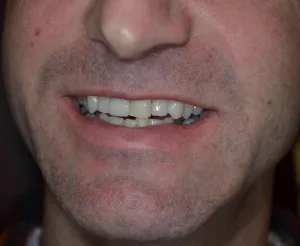 front tooth after