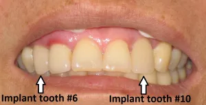 upper teeth after