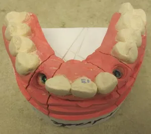 upper tooth mold