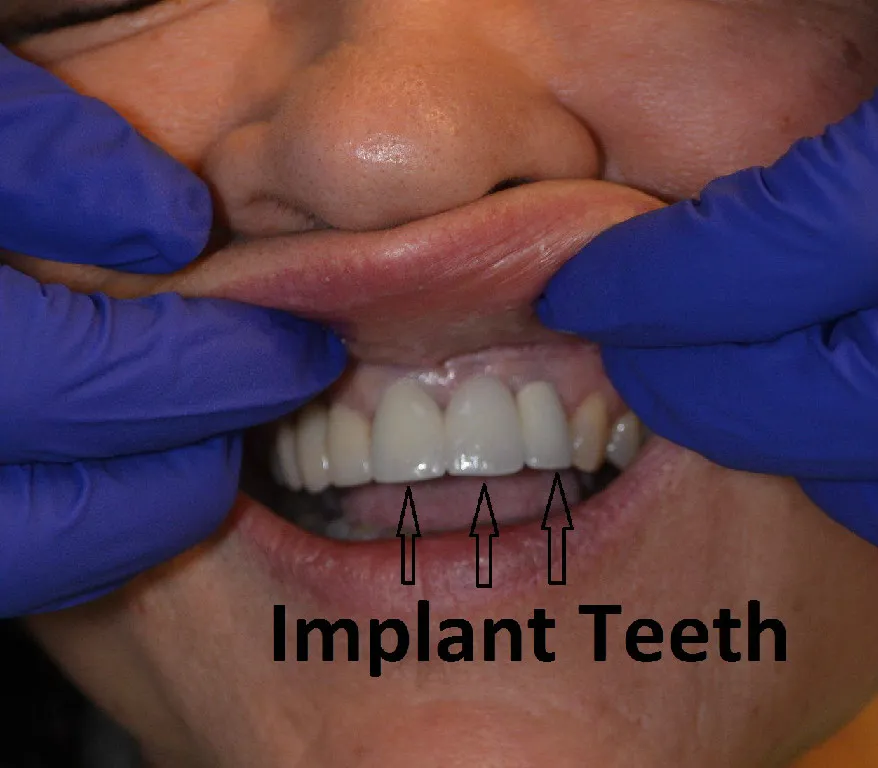 two teeth extractions and implants